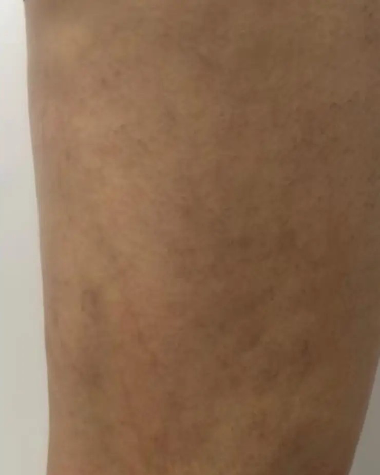 Perna depois do tratamento de varizes