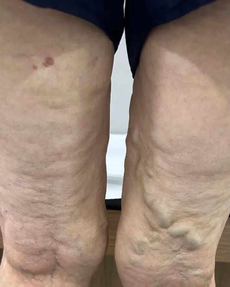 Pernas antes do tratamento de varizes
